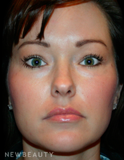 Dr. Kelly Bomer Eyelid Lift - After