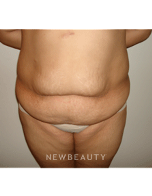 Dr. Michael Horn Tummy Tuck - Before