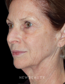 Dr. Min S. Ahn - Lower Facelift and Necklift - Before