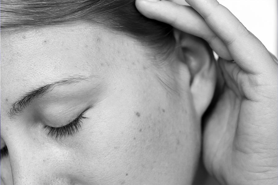 acne sensitive skin
