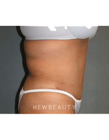 Dr Sean Simon Tummy Tuck, Lipo - After