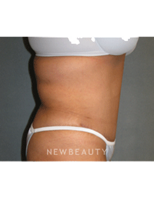 Dr Sean Simon Tummy Tuck, Lipo - After