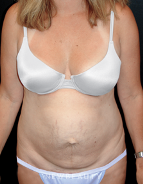 Dr. Mokhtar Asaadi Tummy Tuck, Vaser Lipo - Before