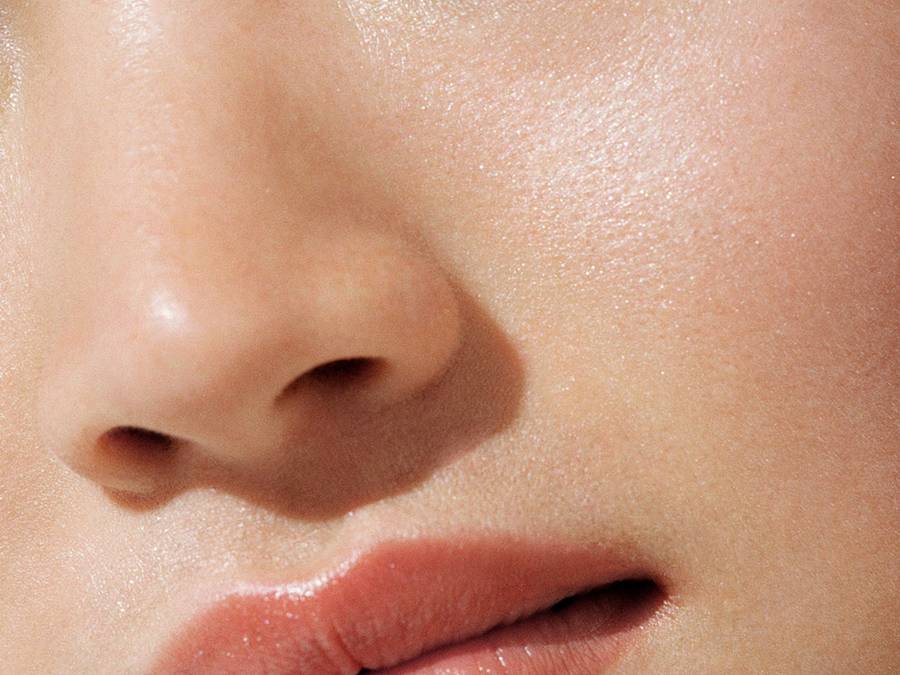 rfblackheads