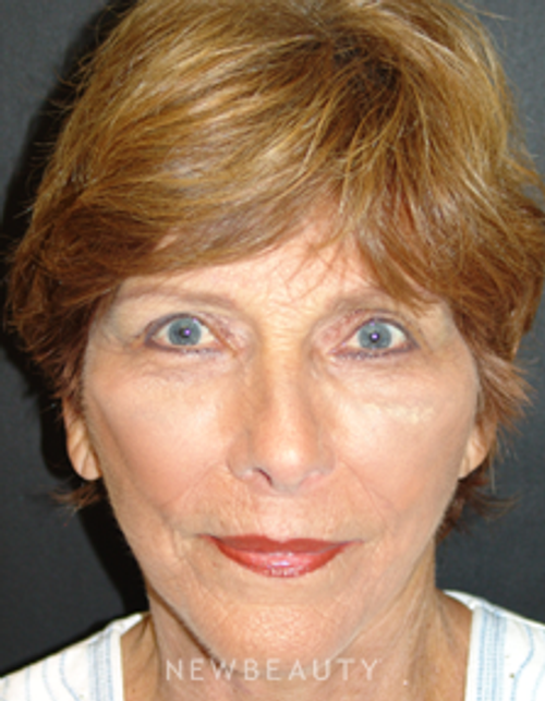 Dr. Mokhtar Asaadi Eyelid Lift, Facelift, Necklift - After
