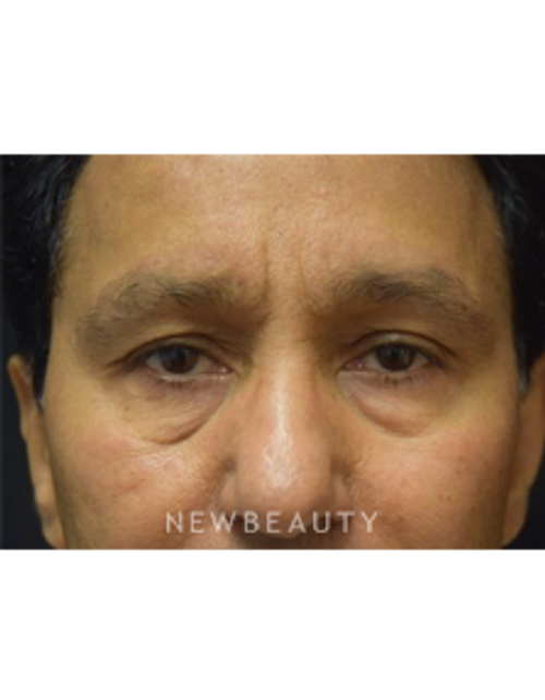 Dr. Jeffrey B. Wise - Lower Blepharoplasty - Before