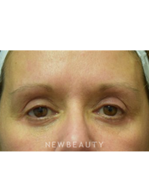 Dr. Jeffrey B. Wise - Blepharoplasty - After
