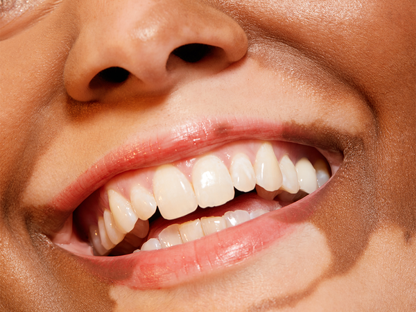 Under the Radar Botox Uses