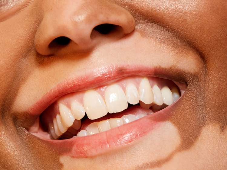 Under the Radar Botox Uses