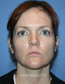 Dr. Kelly Bomer-Liquid Facelift - Before