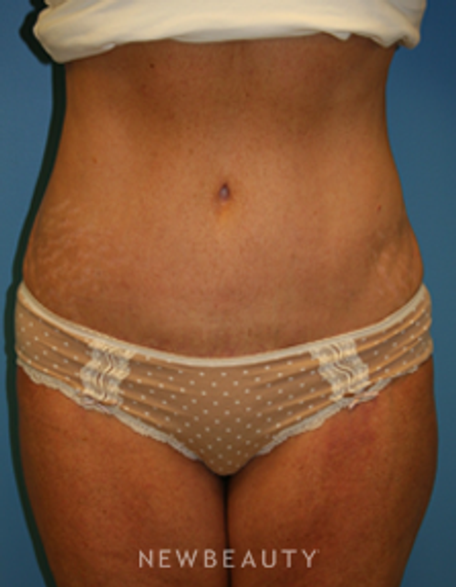 Dr. Christine Hamori Liposuction, Skin TIghtening, Energy-Based - After
