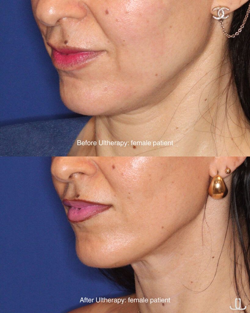 ultherapy before and after