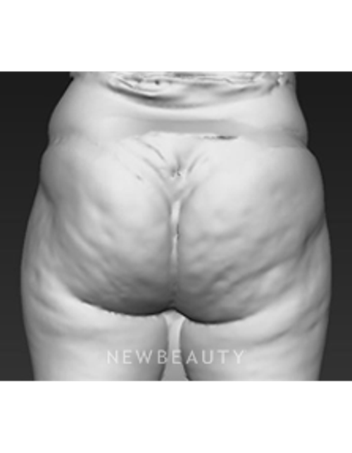 Dr. Brad Bengtson - Cellulite Treatment - Before