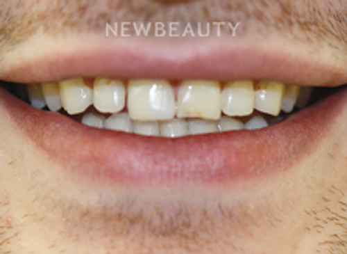 Dr. Joe Kravitz - Veneers - 41419220 - Before