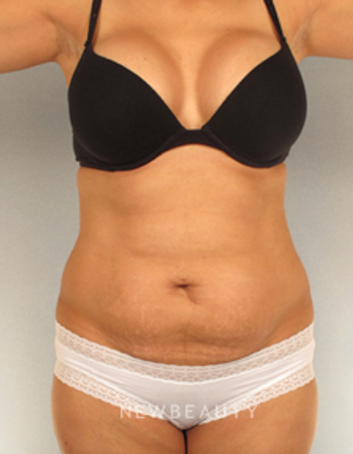 Dr. German Newall - Award-Winning Tummy - Before