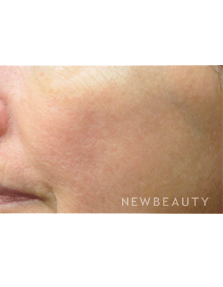 Dr. Jody Levine - Lasers - After