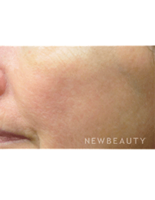 Dr. Jody Levine - Lasers - After