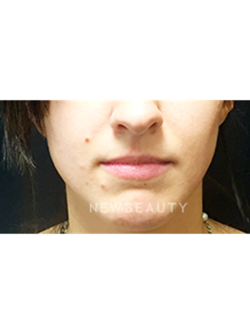 Dr. Jeffrey B. Wise - Lip Enhancement - Before
