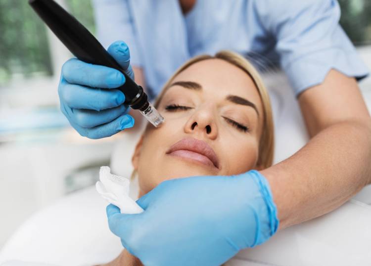 Microneedling
