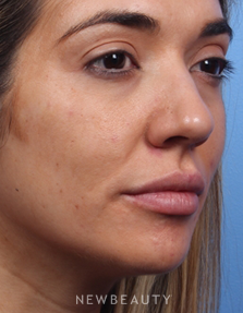 Dr. Kelly Bomer - Juvéderm - After