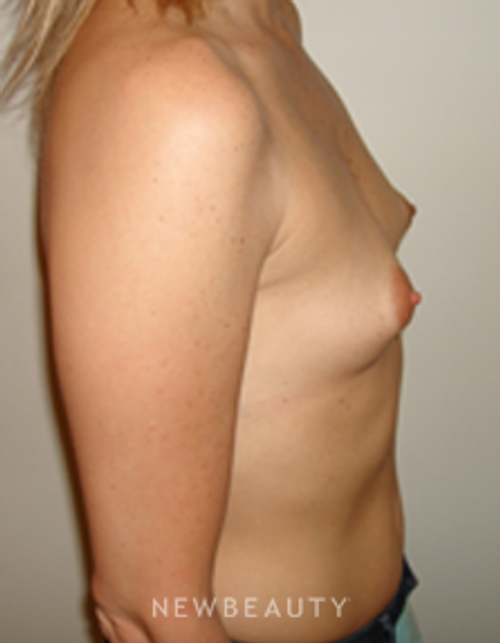 Dr. Michael Horn Breast Augmentation - Before