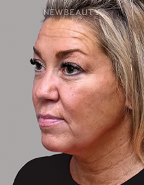 Dr. Michael A. Epstein - Elegant Facial Rejuvenation - 33109024 - Before