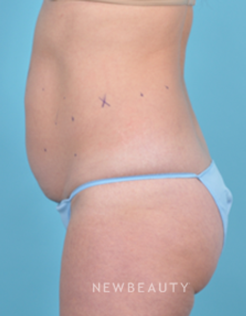 Dr. Bradley Bengtson - CoolSculpting - Before