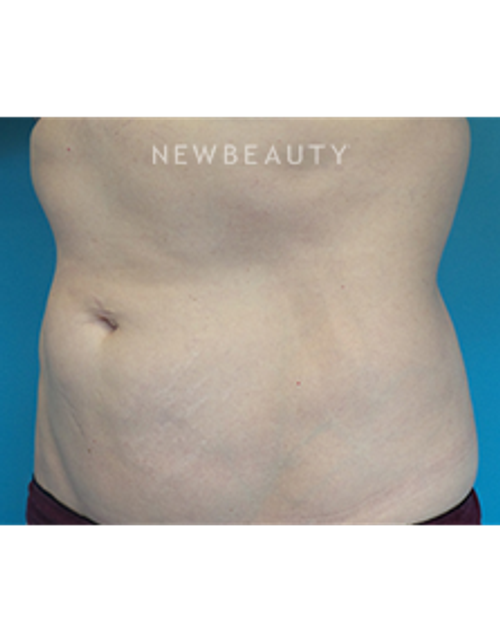 Dr. Christine Hamori - Liposuction - After