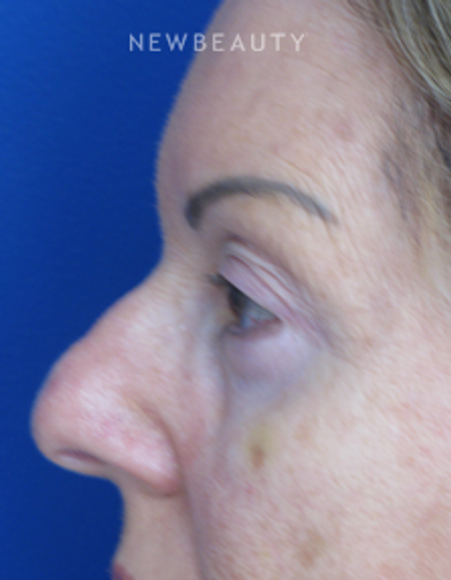 Dr. Joseph Russo - Refreshed and Restored (Eye EBG) - After