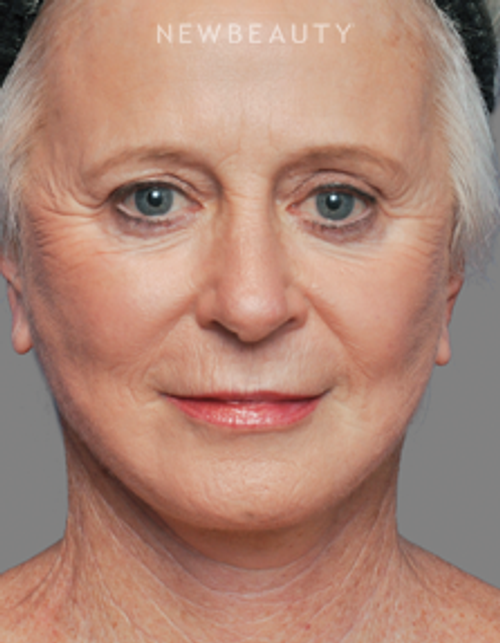 Dr. Alan Durkin - Facelift with Fat Transfer - After