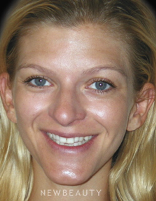 Dr. Irene Grafman - Smile Makeover - Before