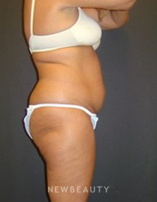 Dr. Joel Schlessinger - SmartLipo - Before