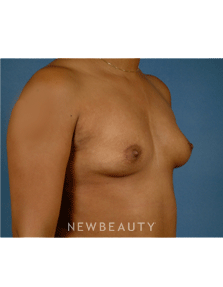 Dr. Bradley Calobrace Breast Augmentation - Before
