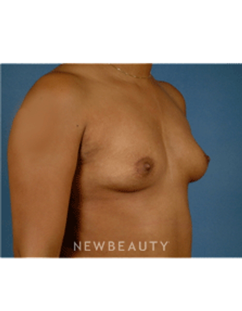 Dr. Bradley Calobrace Breast Augmentation - Before