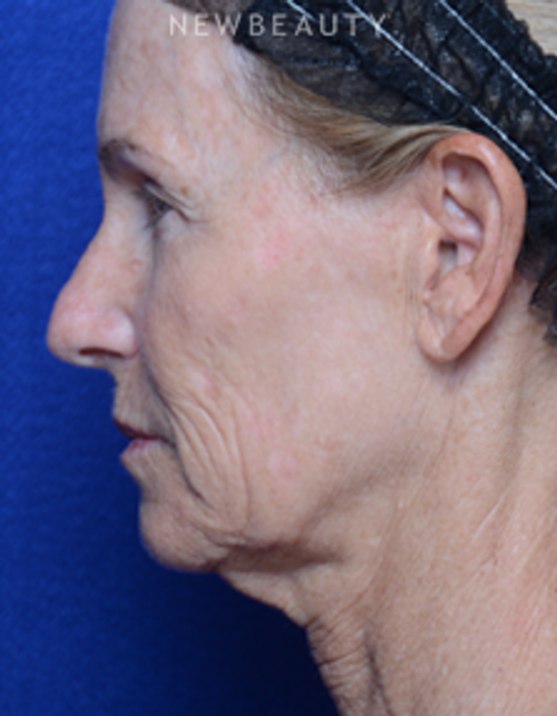 Dr. Alan Durkin - Facelift - Before