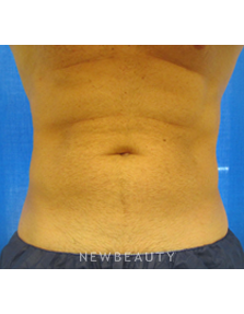 Dr. Edward Kwak - CoolSculpting - After