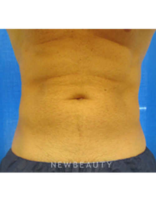 Dr. Edward Kwak - CoolSculpting - After