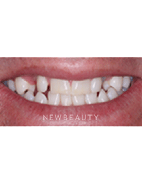 Dr. Neal Patel Smile Makeover - Before