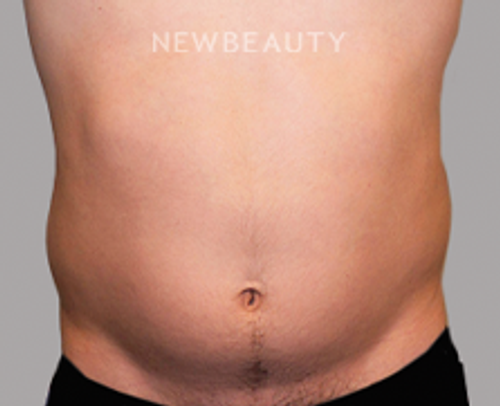 Dr. Sanjay Grover - Liposuction - 49728179 - Before