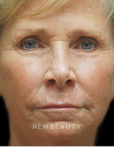 Dr. Kenneth Beer Aesthetic Injectables - After