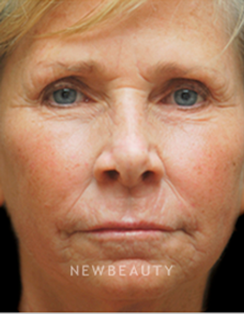 Dr. Kenneth Beer Aesthetic Injectables - After