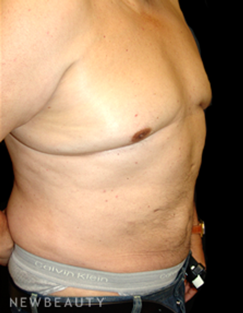 Dr. Mokhtar Asaadi Liposuction - After