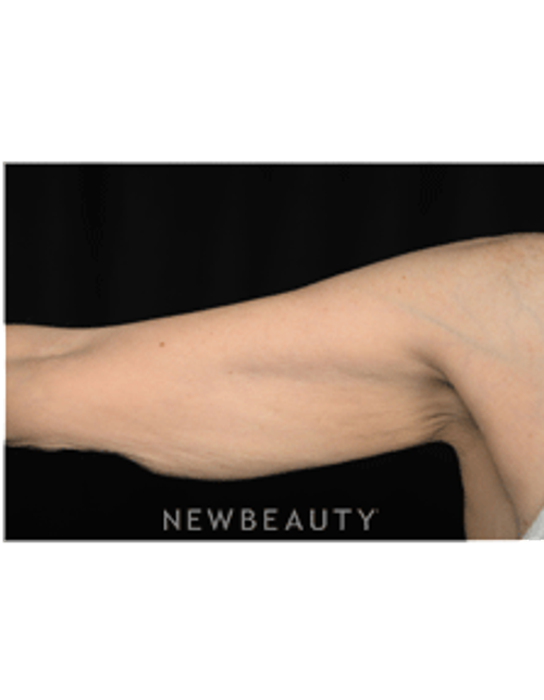 Dr. Hillelson - Skin Tightening - Before
