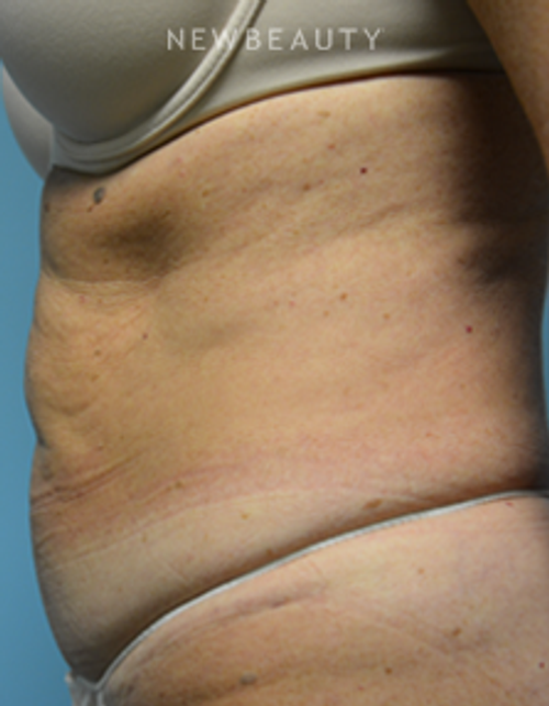 Dr. Ruth Hillelson - Thermage - Before