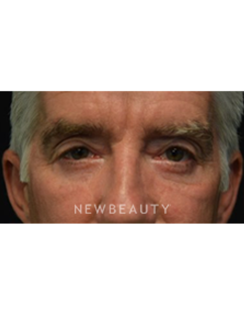 Dr. Jeffrey B. Wise - Eyelift - After