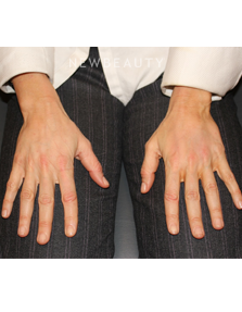 Dr. Dilip Madnani - Radiesse - 13690858 - After