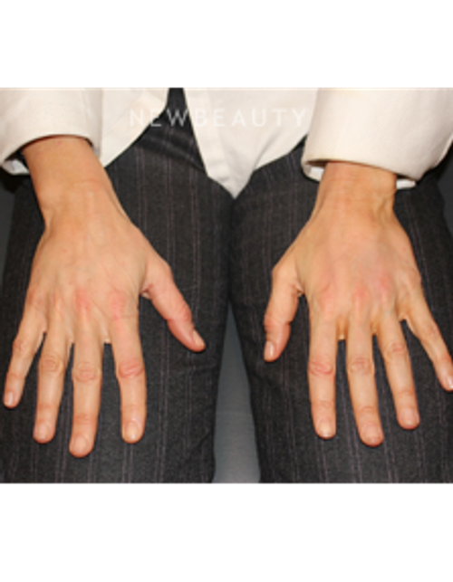 Dr. Dilip Madnani - Radiesse - 13690858 - After