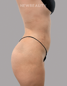 Dr. Daniel Crane – Liposuction - 46167241 - After