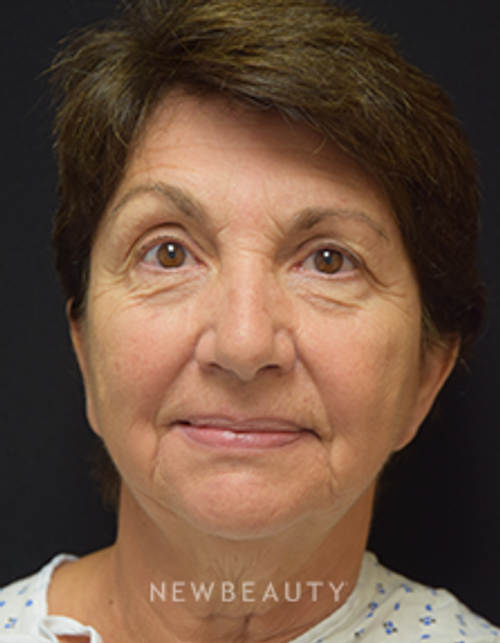 Dr. Jeffrey B. Wise - Eyelift, Facelift & Lasers - Before