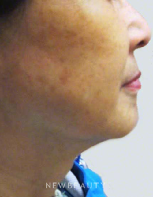 Dr. Kally Papantoniou - Ulthera - After